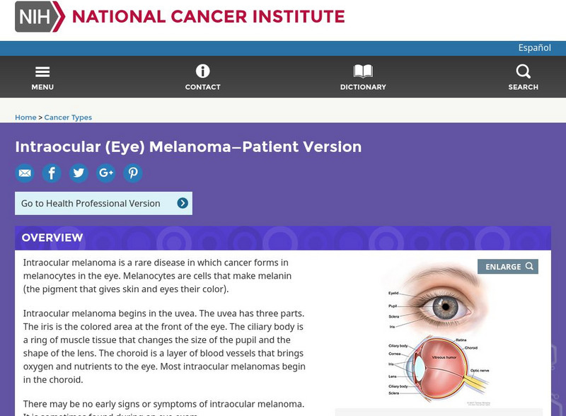 Cancer.gov: Intraocular (Eye) Melanoma Handout Cancer.gov: Intraocular (Eye) Melanoma Handout