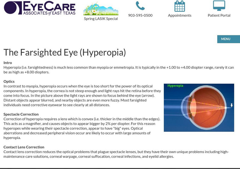 Hyperopia the Farsighted Eye Handout