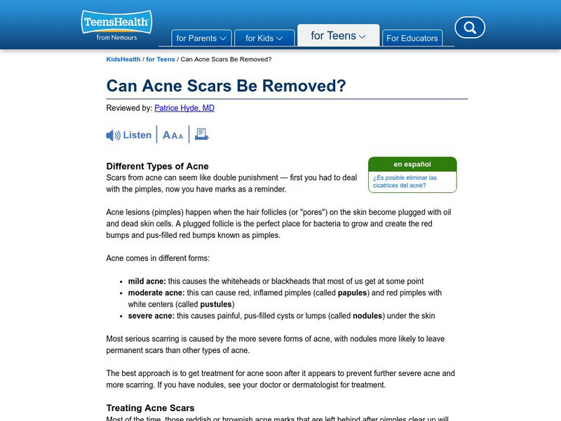 Kids Health: Can Acne Scars Be Removed? Article