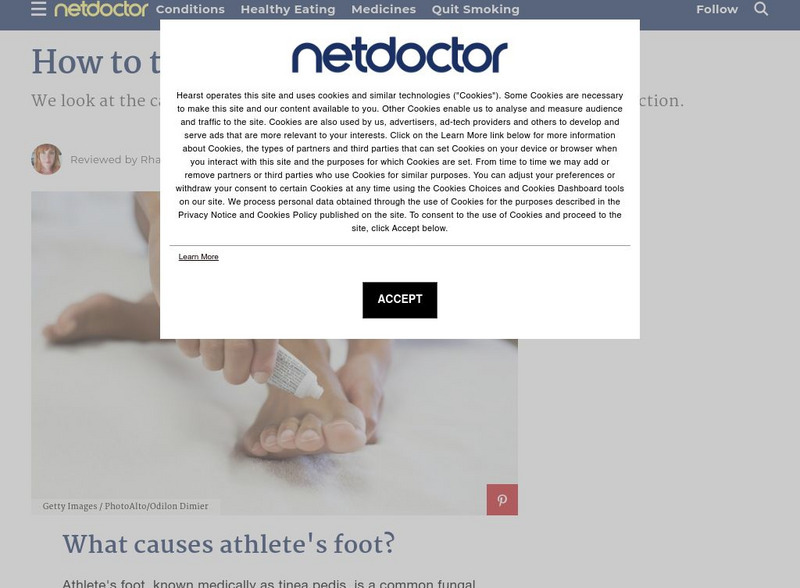 Athlete's Foot (Tinea Pedis) Handout