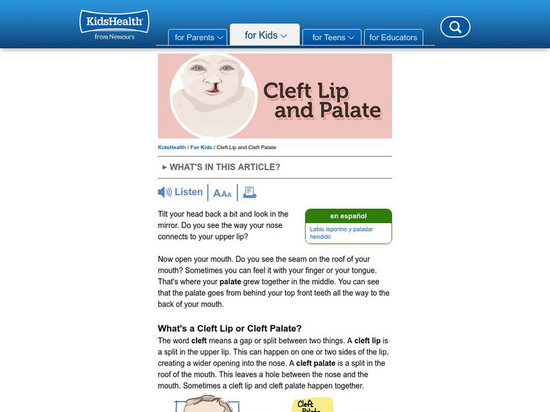Kids Health: Cleft Lip and Cleft Palate Handout Kids Health: Cleft Lip and Cleft Palate Handout