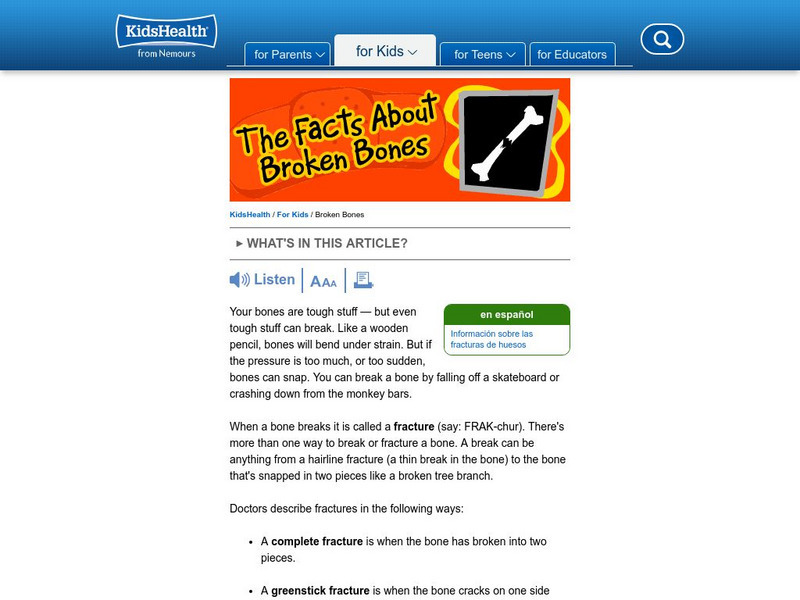Kids Health: The Facts About Fractures and Broken Bones Handout Kids Health: The Facts About Fractures and Broken Bones Handout