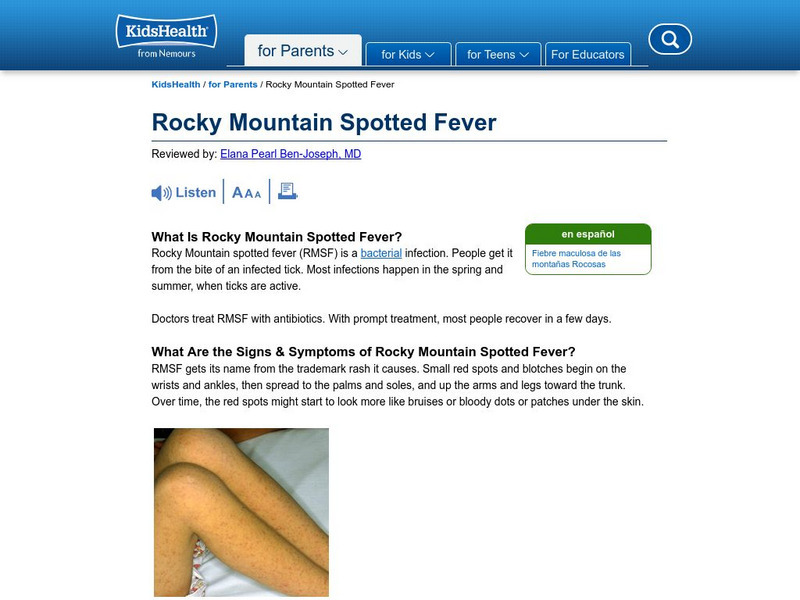Kids Health: Rocky Mountain Spotted Fever Signs and Symtoms Handout Kids Health: Rocky Mountain Spotted Fever Signs and Symtoms Handout