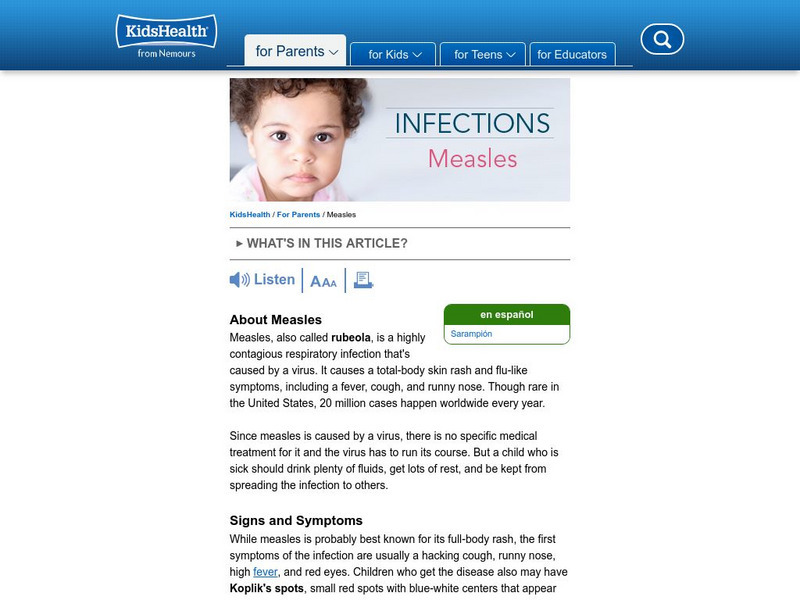 Kids Health: Rubeola (Measles) Handout Kids Health: Rubeola (Measles) Handout