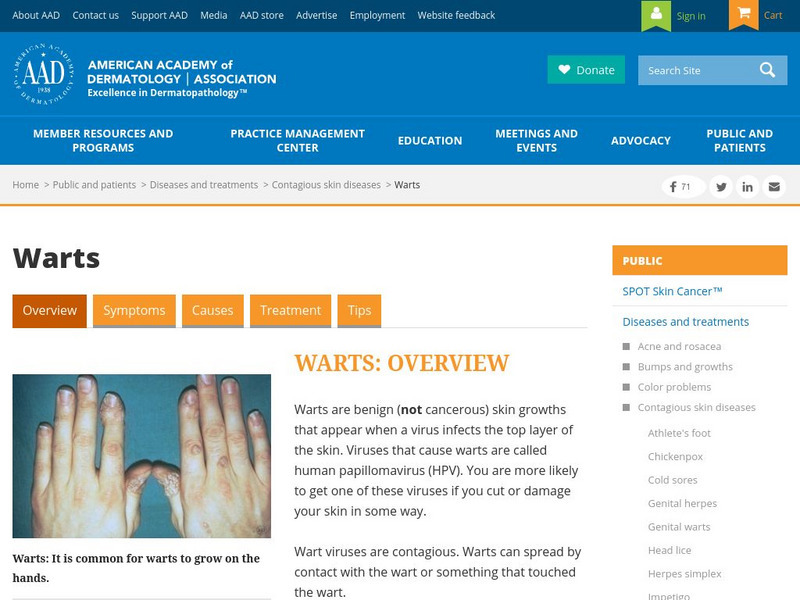 American Academy of Dermatology: Warts Website