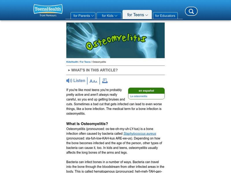 Kids Health: Osteomyelitis Article Kids Health: Osteomyelitis Article