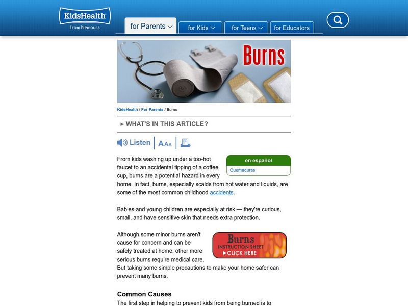 Kids Health: Burns Article Kids Health: Burns Article