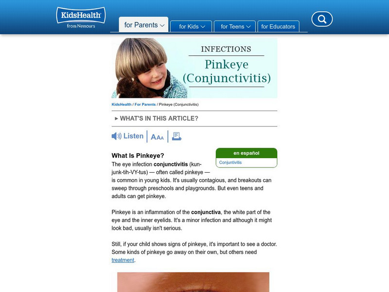 Kids Health: Conjunctivitis (Pinkeye) Article Kids Health: Conjunctivitis (Pinkeye) Article