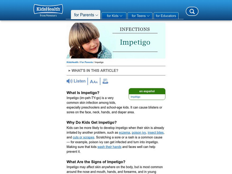Kids Health: Impetigo Article Kids Health: Impetigo Article
