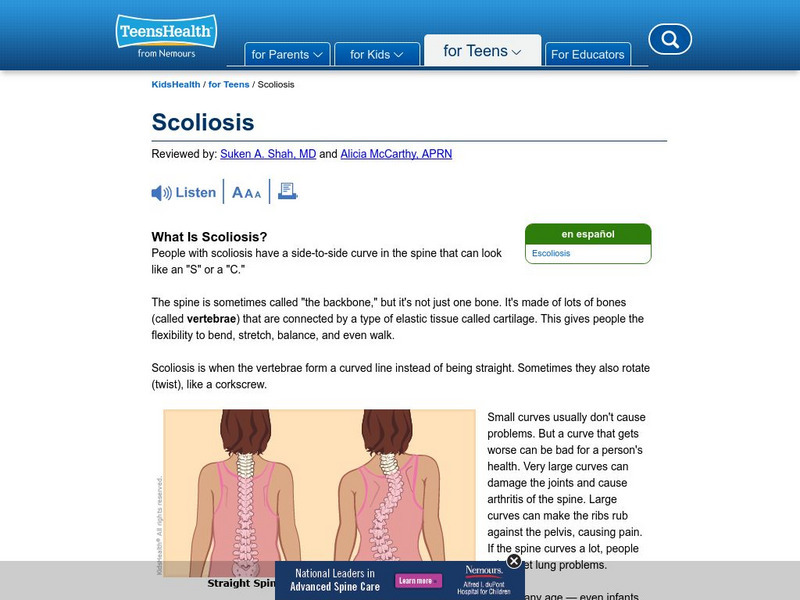 Kids Health: Scoliosis Article Kids Health: Scoliosis Article