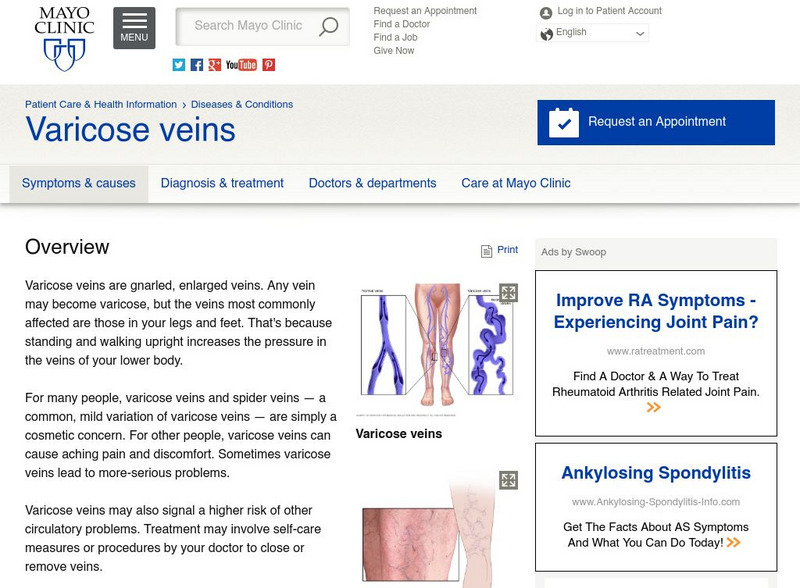Mayo Clinic: Varicose Veins Handout