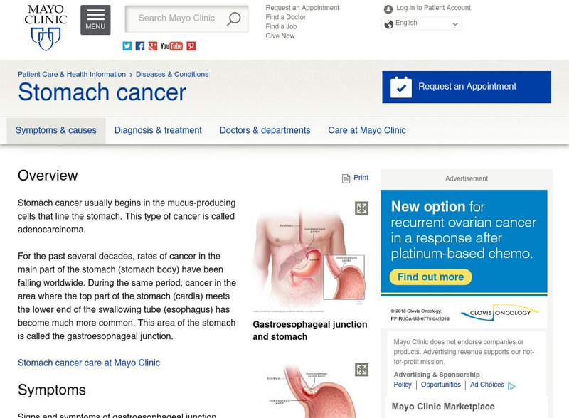 Mayo Clinic: Stomach Cancer Overview Handout