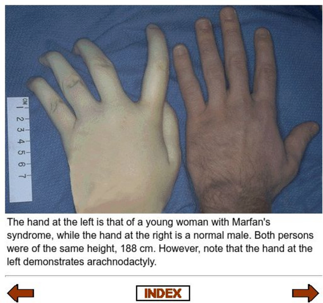 University of Utah: Photograph of Marfan Syndrome Hand Graphic University of Utah: Photograph of Marfan Syndrome Hand Graphic
