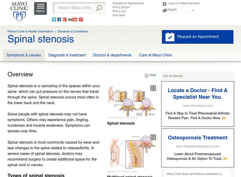 Mayo Clinic: Spinal Stenosis Handout Mayo Clinic: Spinal Stenosis Handout