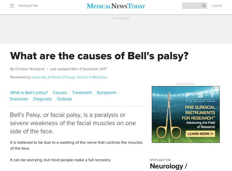 Medical News Today: Articles: Neurology: What Is Bell's Palsy? Handout