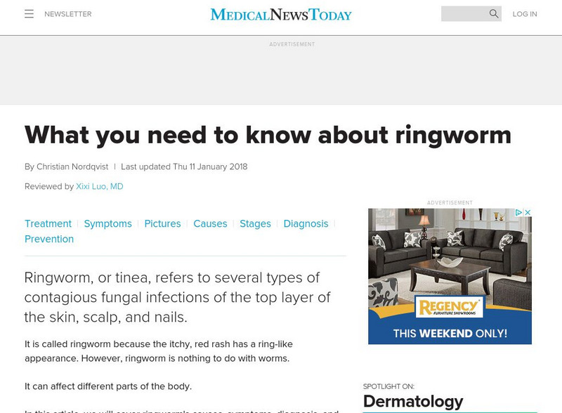 Medical News Today: What Is Ringworm? Handout Medical News Today: What Is Ringworm? Handout