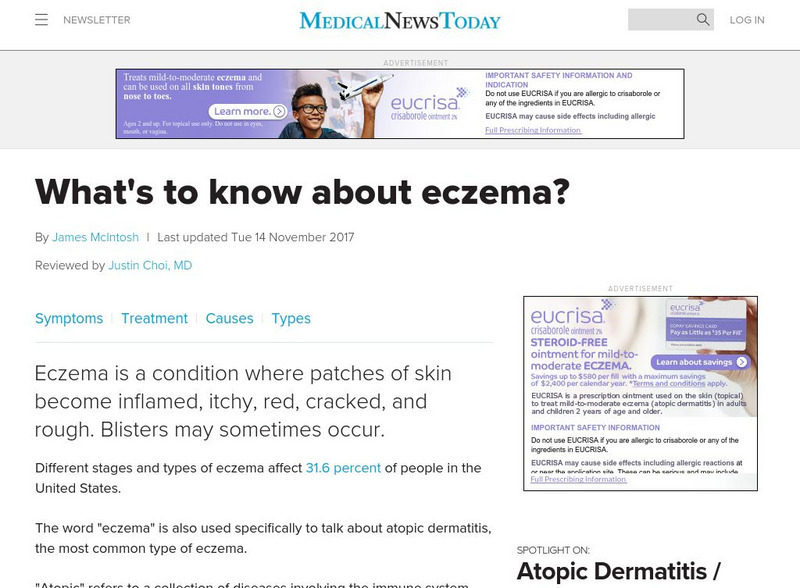 Medical News Today: Articles: Eczema: What Is Eczema? Handout
