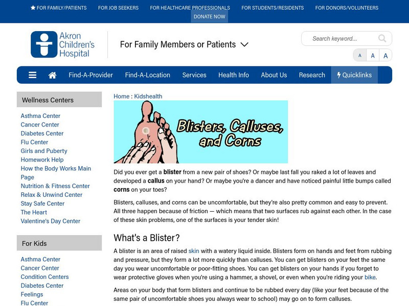 Akron Children's Hospital: Kidshealth: Blisters, Calluses, and Corns Article Akron Children's Hospital: Kidshealth: Blisters, Calluses, and Corns Article