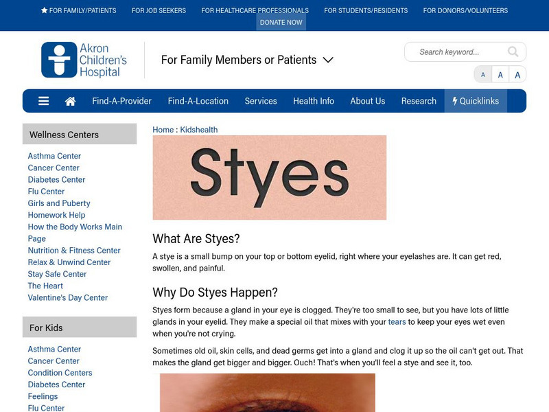 Akron Children's Hospital: Kidshealth: Styes Article