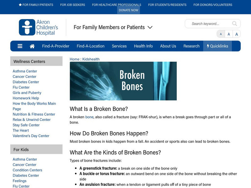 Akron Children's Hospital: Kidshealth: The Facts About Broken Bones Article Akron Children's Hospital: Kidshealth: The Facts About Broken Bones Article