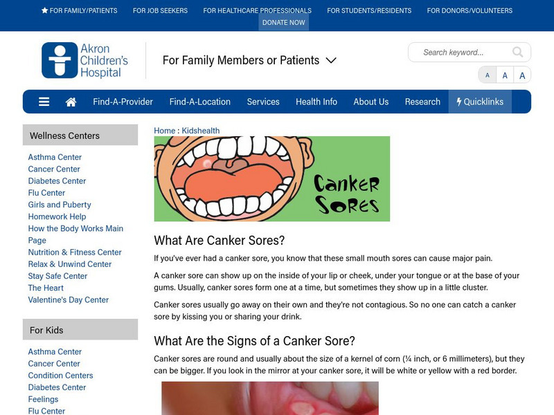 Akron Children's Hospital: Kidshealth: Canker Sores Article Akron Children's Hospital: Kidshealth: Canker Sores Article