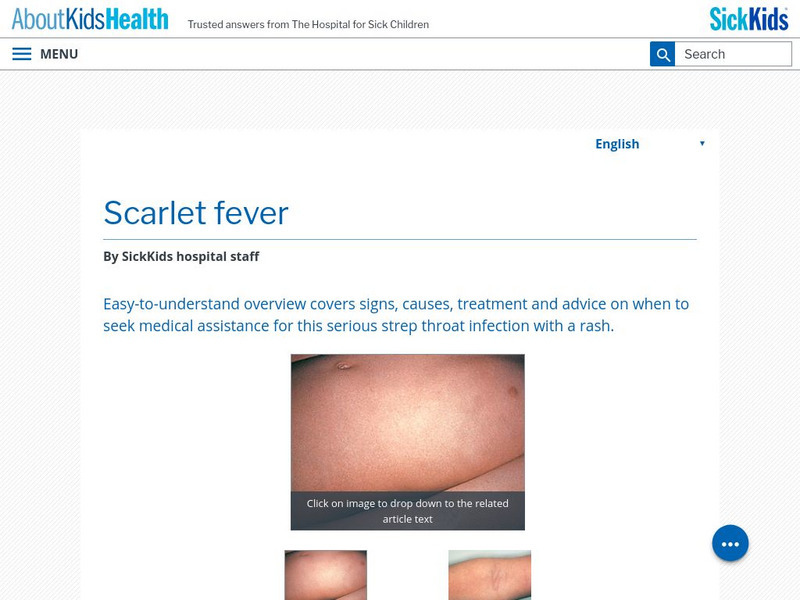 About Kids Health: Scarlet Fever Handout About Kids Health: Scarlet Fever Handout