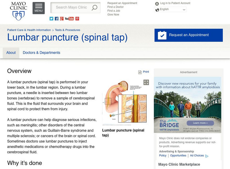 Mayo Clinic: Spinal Tap Q&a Handout