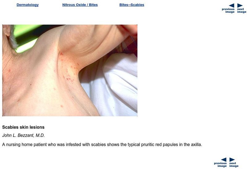 University of Utah: Pictures of Patients With Scabies Graphic