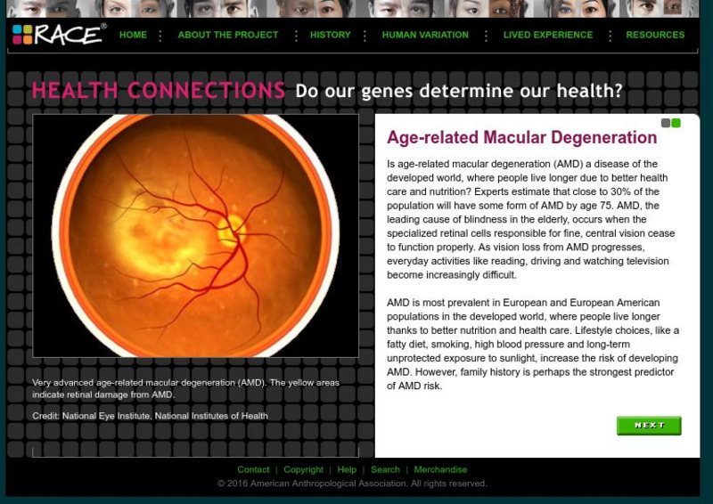 Understanding Race: Age Related Macular Degeneration Handout
