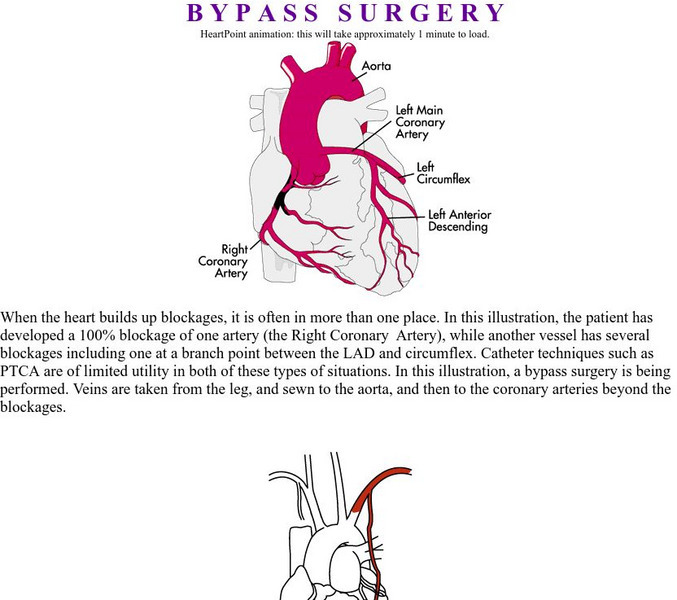 Heart Point: Bypass Surgery Activity Heart Point: Bypass Surgery Activity