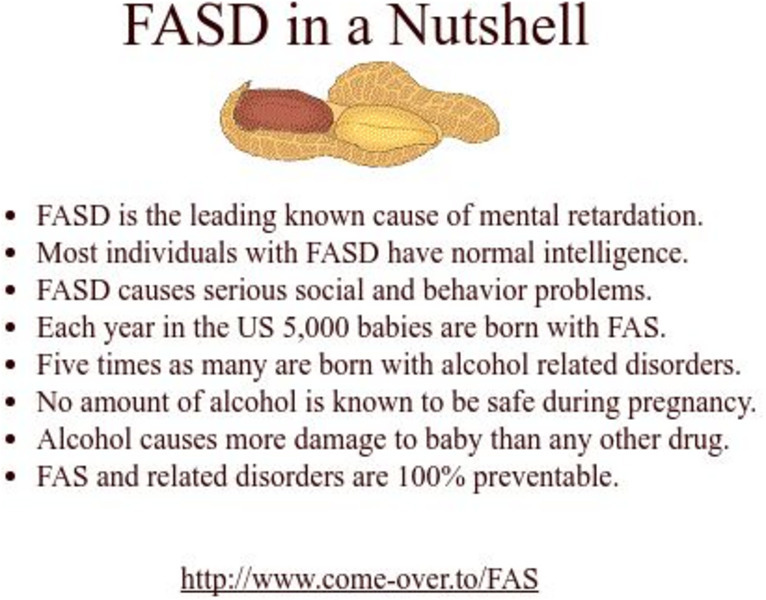 Fetal Alcohol Syndrome in a Nutshell Handout Fetal Alcohol Syndrome in a Nutshell Handout