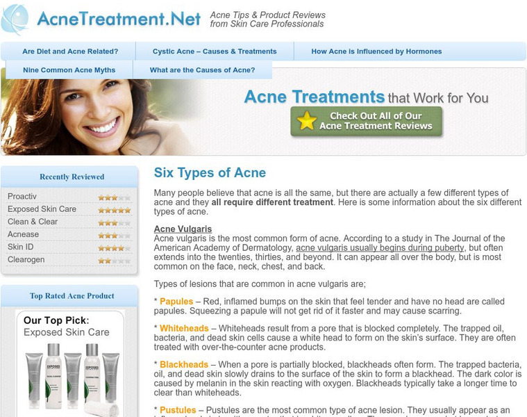 Acne treatment.net: Six Types of Acne Handout